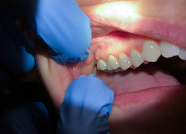 Best Tooth Infection Emergency Dentist  in Kennett Square, PA